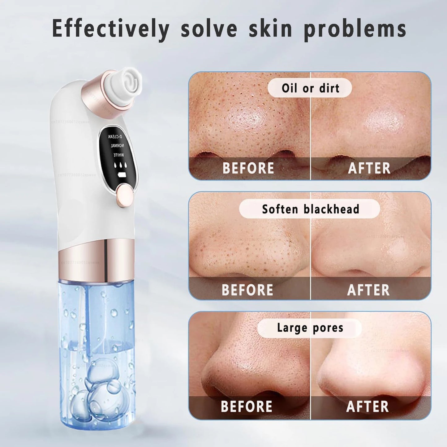 Deep Cleansing Blackhead Remover with Water Cycle Technology – Deep Pore Cleansing & Skin Care Vacuum for Blackheads and Acne